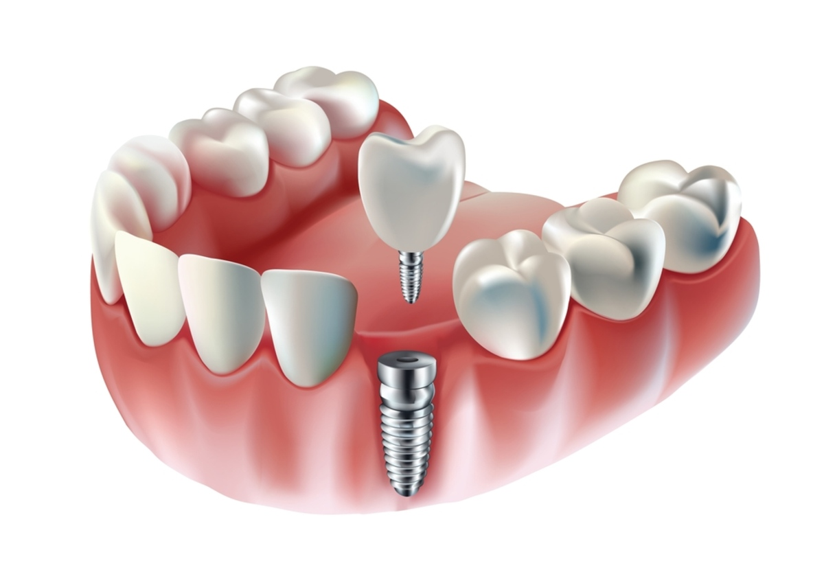 Công nghệ hiện đại, quy trình điều trị chuẩn hóa và đội ngũ bác sĩ giàu kinh nghiệm giúp nâng cao tỷ lệ thành công khi cấy ghép Implant